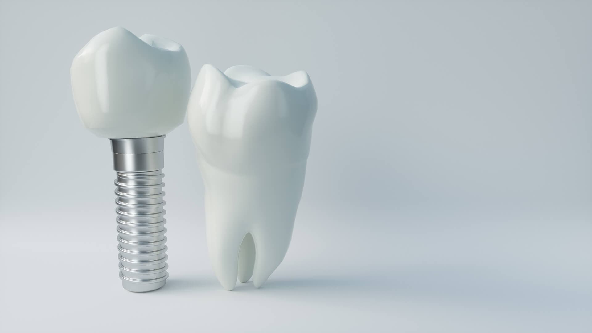 ¿Qué es un implante dental?