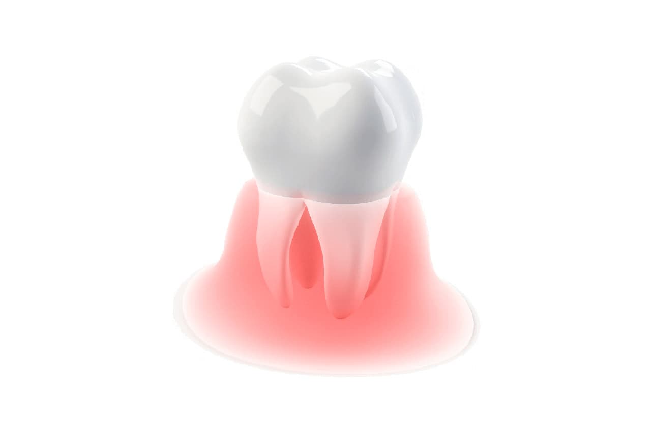Síntomas de la enfermedad periodontal