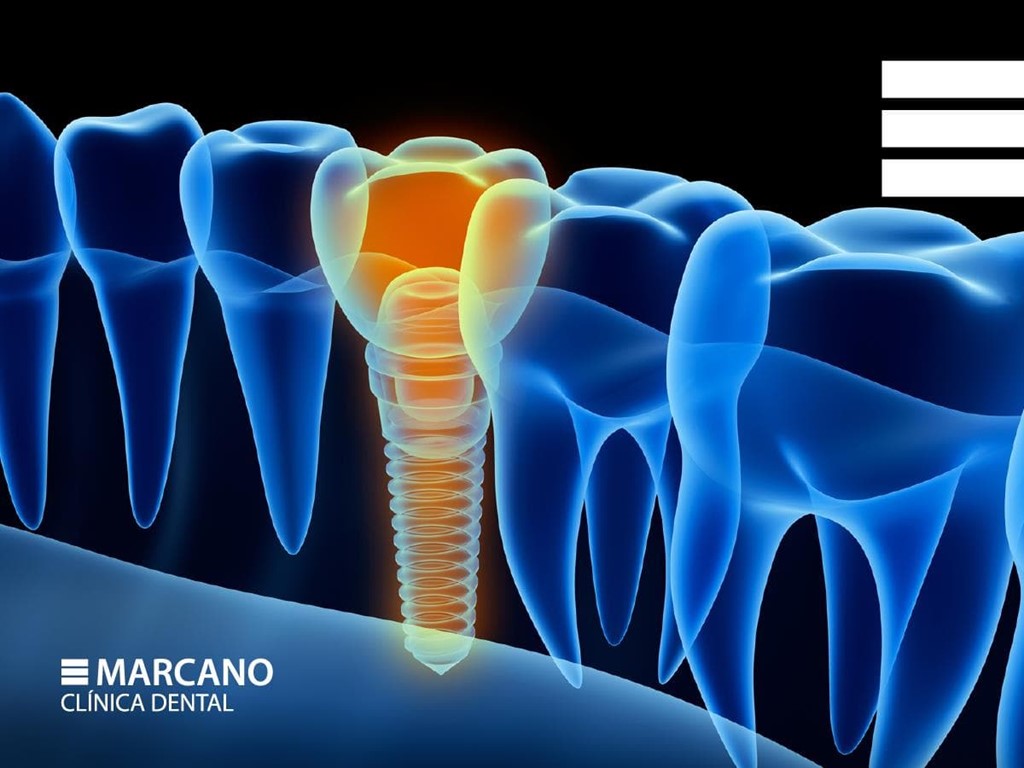 Todo lo que necesitas saber sobre los implantes dentales