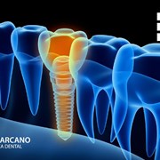Todo lo que necesitas saber sobre los implantes dentales